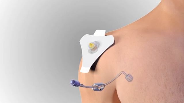 Humerus Insertion EZ-IO - Official access method смотреть онлайн