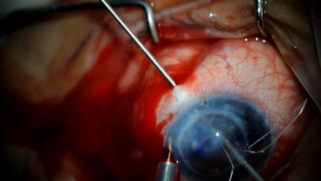 Combined PKP + IOL scleral fixation смотреть онлайн