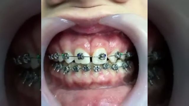 Лечение брекетами! смотреть онлайн