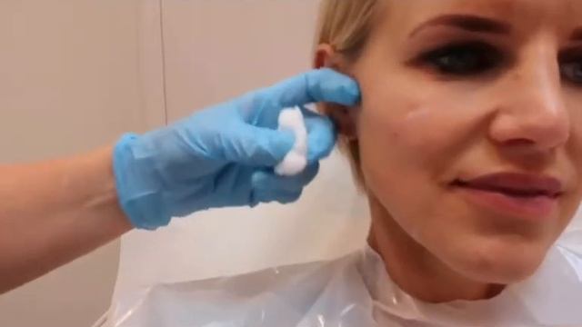 Belotero Volume Cheek Treatment