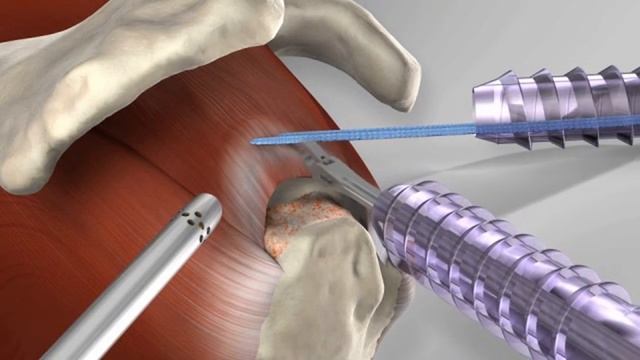 Knotless Rotator Cuff Repair with Arthrex® SpeedFix™ смотреть онлайн