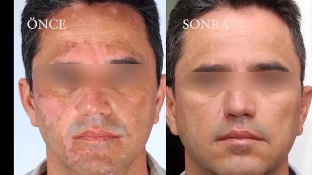 Nohutla Vitiligo Tedavisi Chickpea Vitiligo Treatment смотреть онлайн