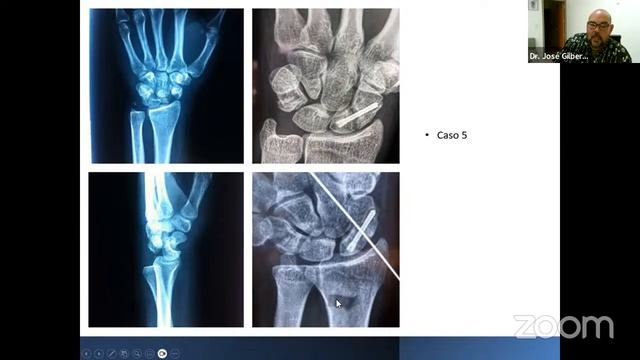 Abordando las lesiones del carpo, agudo y secuelas смотреть онлайн