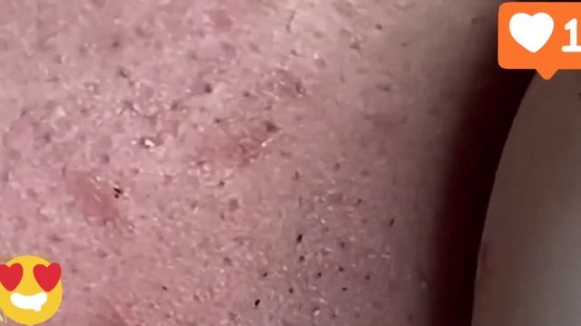 The Back Is Full Of Blackheads #pimple #blackheadremoval #acne #removal