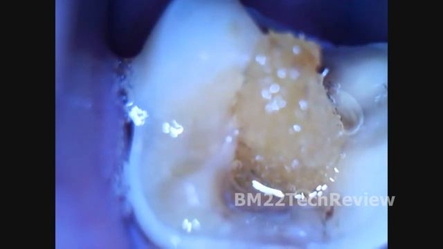 Broken Tooth with Root Canal: Dental PSA смотреть онлайн