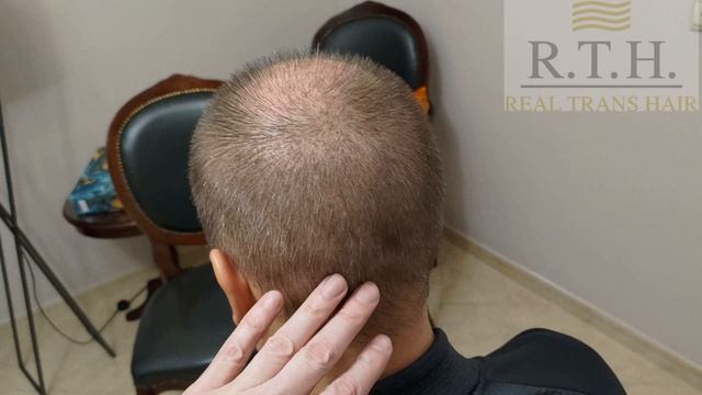 3 недели после пересадки волос🔥 смотреть онлайн