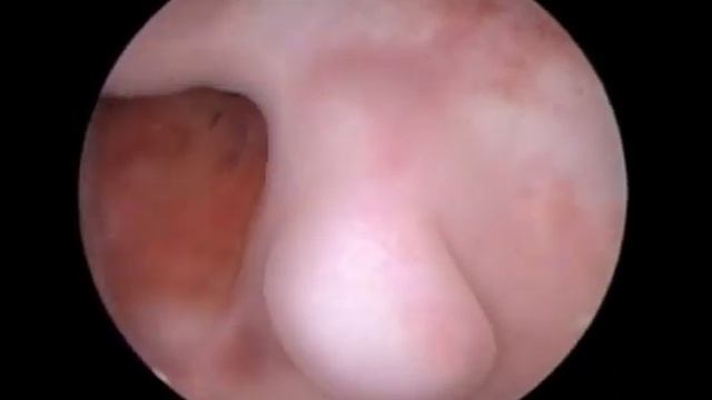 Vaginoscopy of cervical tears смотреть онлайн