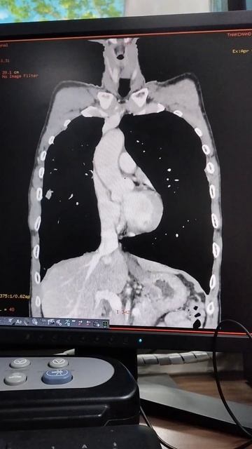 CT SCAN OF CHEST.#viral #medical #shortfeeds #1000subscriber #million #angiography . смотреть онлайн