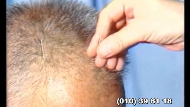 Acupuncture For Headaches;Иглотерапия при лечении головных болей