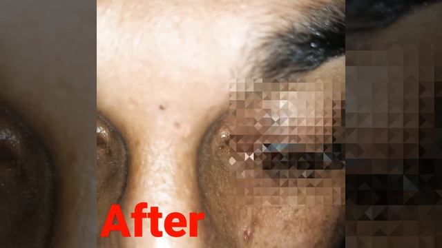 #shortsyoutube#mole removal #skin #shorts смотреть онлайн