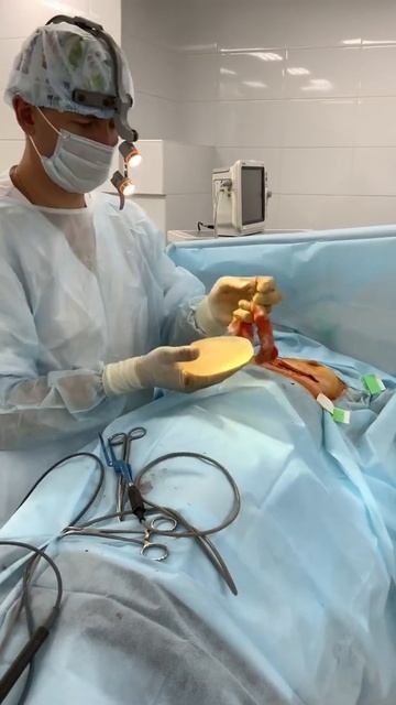 Извлечение импланта из груди, будет замена смотреть онлайн