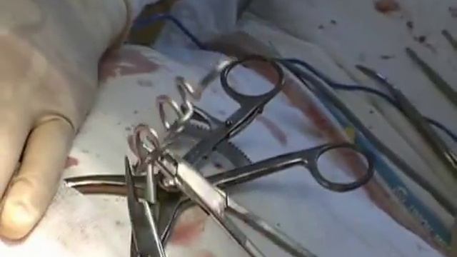 Динамические скобы с памятью формы на позвоночнике смотреть онлайн