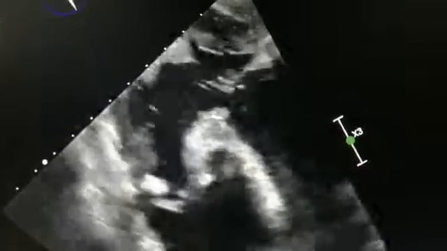 Severe pulmonary stenosis, transgastric RV inflow-outflow view смотреть онлайн