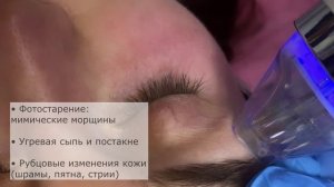 Микроигольчатый РФ лифтинг в клинике «Артевита»