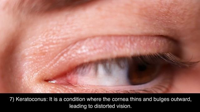The Human Eye Disorders/Disease || Myopia, Hyperopia, Astigmatism, Presbyopia, Etc. || Physiology смотреть онлайн