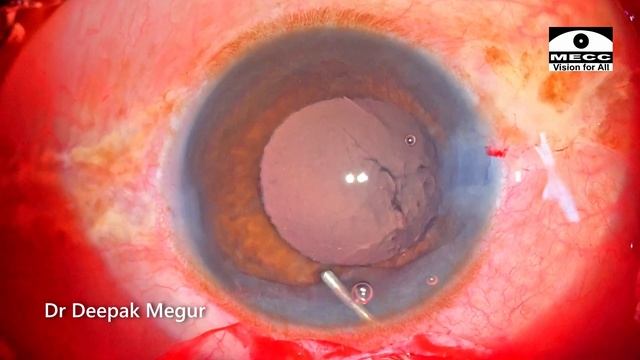 The 3 tips for Iris Claw Lens Implantation - Dr Deepak Megur смотреть онлайн