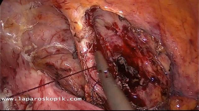 Bladder Injury. Laparoscopic Repair ( laser surgery for anal fistula ). Metin Ertem MD FACS смотреть онлайн