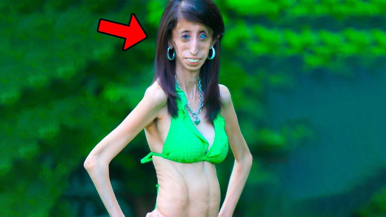 Помните самую худую женщину в мире? Вы не поверите, как она выглядит сейчас! смотреть онлайн