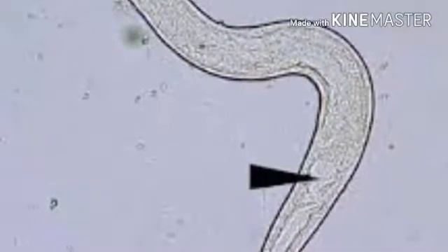 Strongyloides Stercoralis In Stool Microscopic Examination