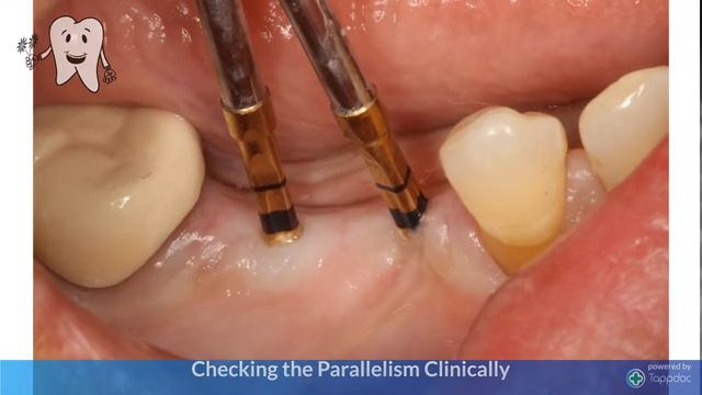 Parallel Implant Placement Smart and Simple technique смотреть онлайн