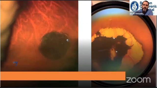 Lesiones Intraoculares Primarias más frecuentes en adultos y niños смотреть онлайн