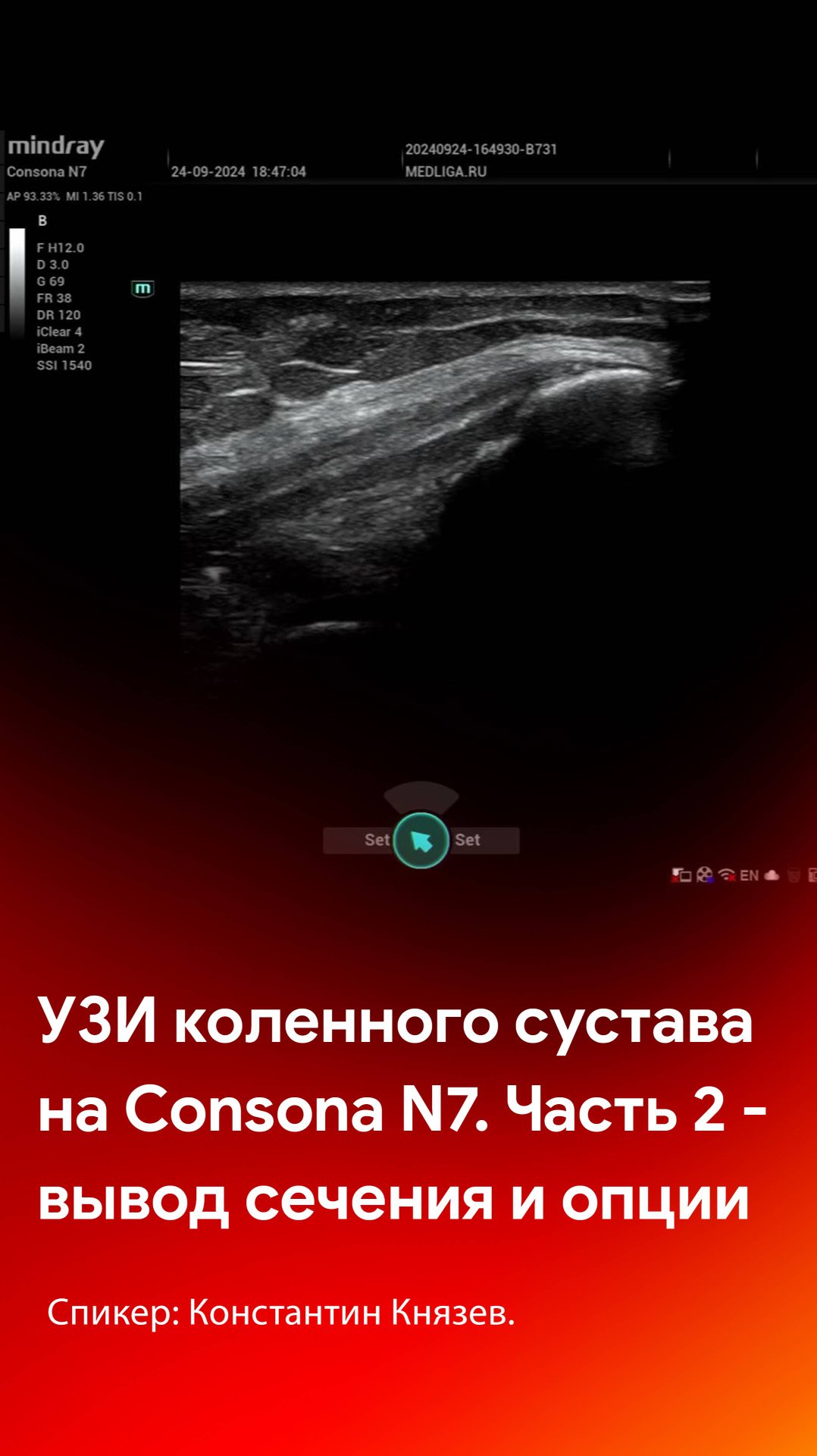 УЗИ коленного сустава на Mindray Consona N7. Часть 2 - вывод сечения и опции смотреть онлайн