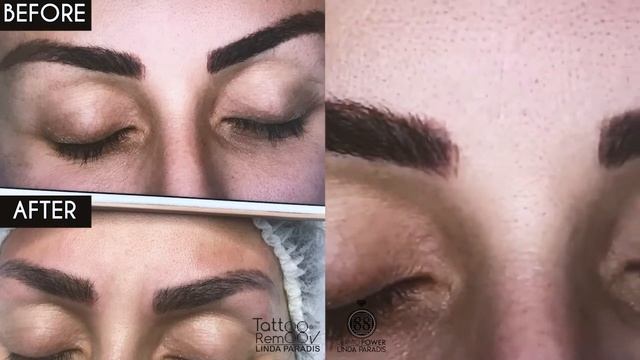 Before After 7 / Magnetic PMU Tattoo Removal | by Linda Paradis смотреть онлайн