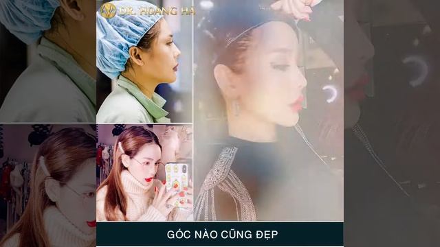 Mô Phỏng 3D Kỹ Thuật Độn Trán - Dr Hoàng Hà смотреть онлайн