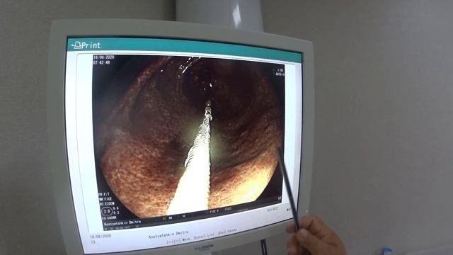 Сучасна ендоскопія в Хмельницькому. смотреть онлайн