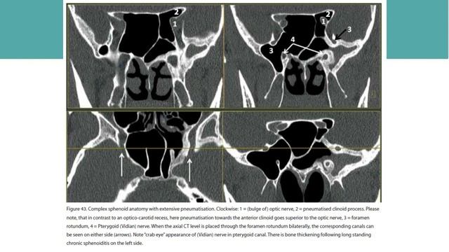 Latest Anatomical Terminology of the Internal Nose and Paranasal Sinuses - European Position Paper смотреть онлайн
