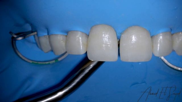 Diastema Closure- Free Hand смотреть онлайн