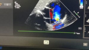 Double outlet right ventricle , Severe Pulmonary Stenosis Common AV Septal Defect DORV