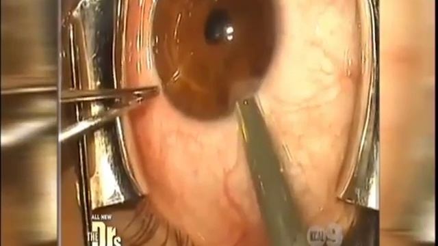 Iris Implants to Change Your Eye Color? Dr. Brian Boxer Wachler discusses on TV show смотреть онлайн