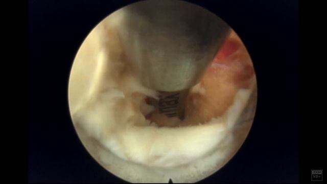 Endoscopic Spine Surgery – Start to Finish Lumbar Discectomy with Dr. Peter Derman and Son смотреть онлайн