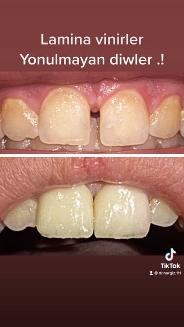#diastema Lı Dişlərin #lamina #vinir Lərlə Bərpası.Dişlər Yonulmayıb: +994 51 422 11 11 ☎️