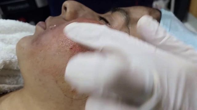 Mesotherapy with PRP by Dr Attiya Tareen ✨ смотреть онлайн