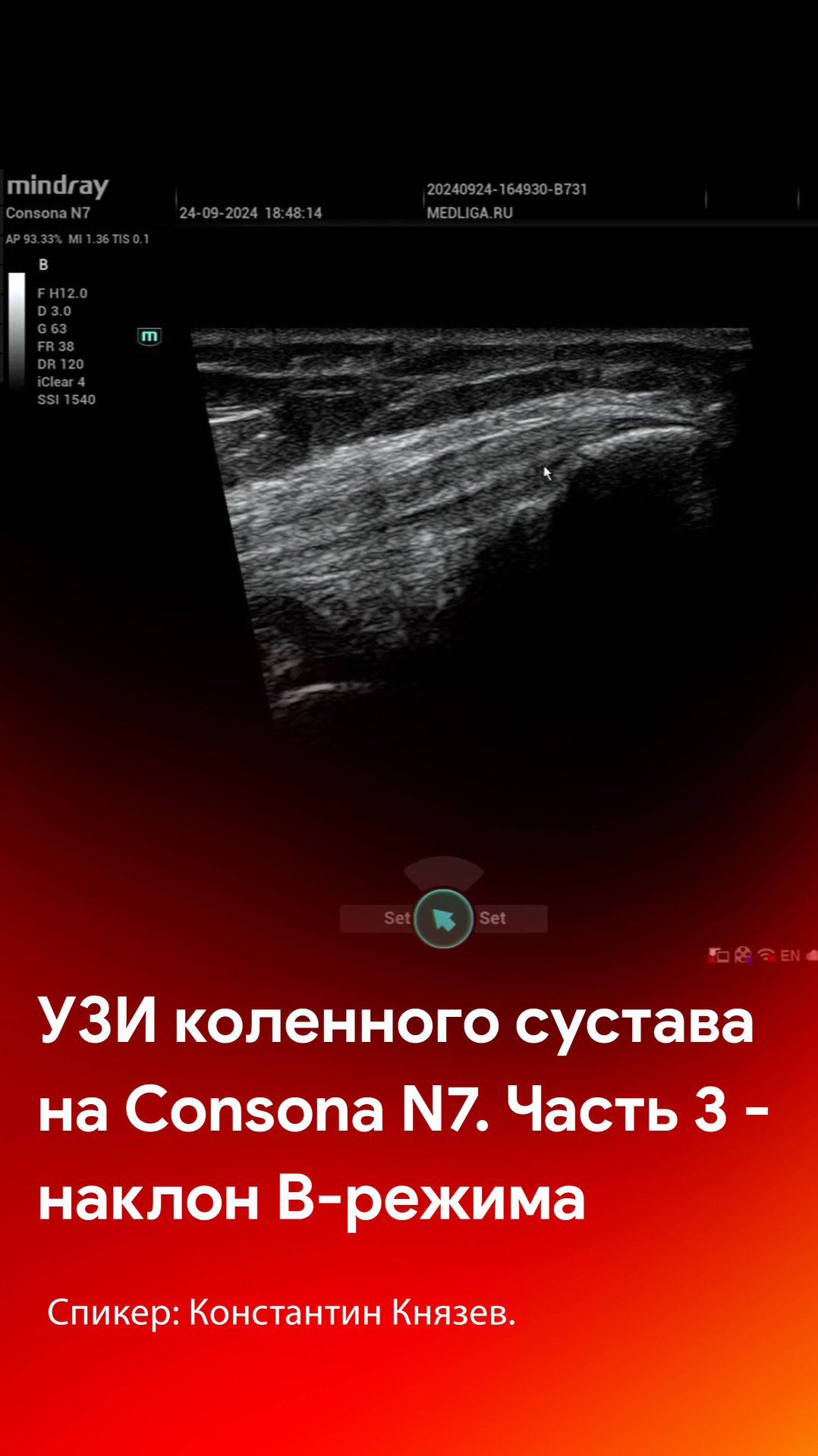 УЗИ коленного сустава на Mindray Consona N7. Часть 3 - наклон B-режима смотреть онлайн