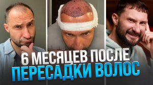 6 месяцев после пересадки волос | Честный отзыв