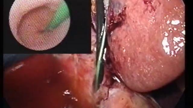 SPHINCTER OF ODDI contractions-LAPAROSCOPIC CHOLANGIOSCOPY смотреть онлайн
