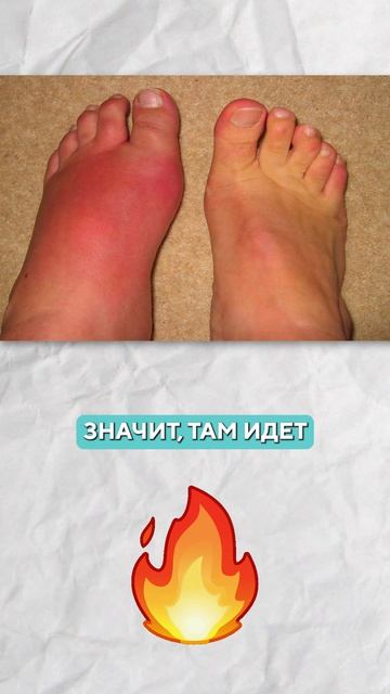 Серьезные ОСЛОЖНЕНИЯ после липолитиков! косметология #липолитики #уходзакожей смотреть онлайн