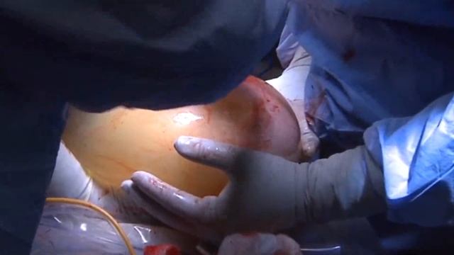 First Baby Delivered in North America Using a Uterus Transplanted from Deceased Donor смотреть онлайн