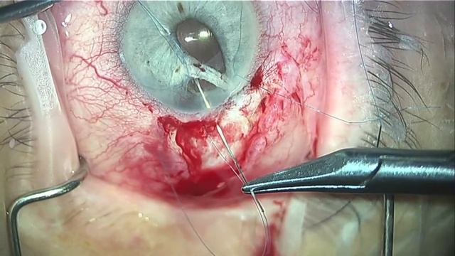 Iridoplasty: suturing the iris смотреть онлайн