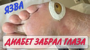 Язва на ноге_диабет стопа_ медицинский педикюр