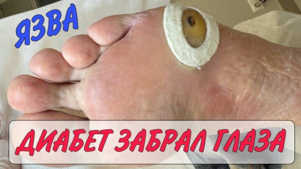Язва на ноге_диабет стопа_ медицинский педикюр