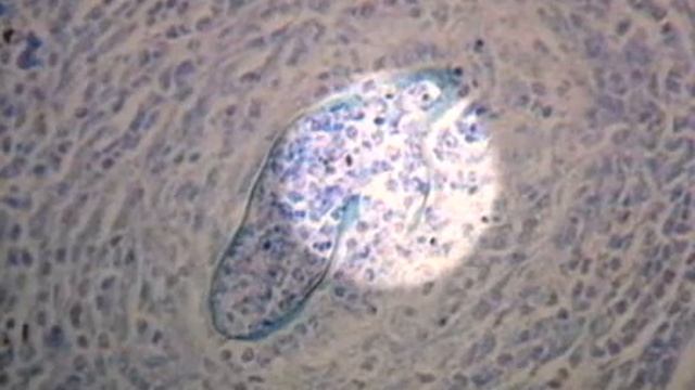 Schistosomiasis (1990) Part 2 of 3 смотреть онлайн