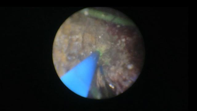 Случай #21 #22. Фиброкаликолитоэкстрация справа. Перкутанная нефролитотрипсия слева. смотреть онлайн