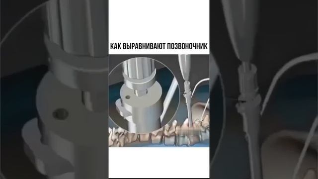 Вправление позвоночника операцией смотреть онлайн
