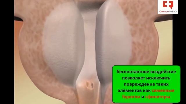Лечение аденомы простаты зеленым лазером - операция лазерной вапоризации простаты смотреть онлайн