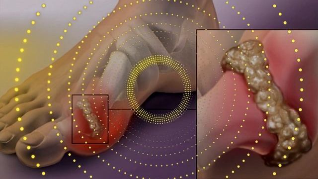 Исцеление Подагры. Бинауральная медитация смотреть онлайн