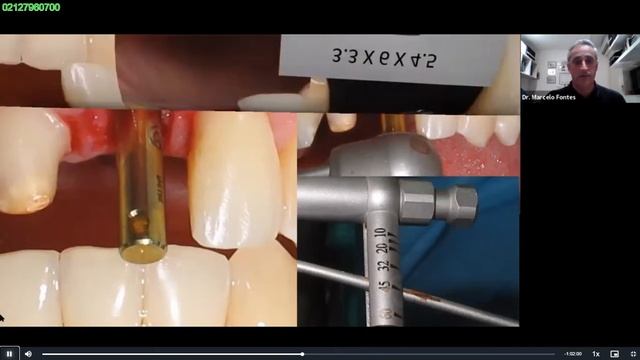 CONE MORSE OU GRAND MORSE - WEBINAR NEODENT - MARCELO FONTES смотреть онлайн
